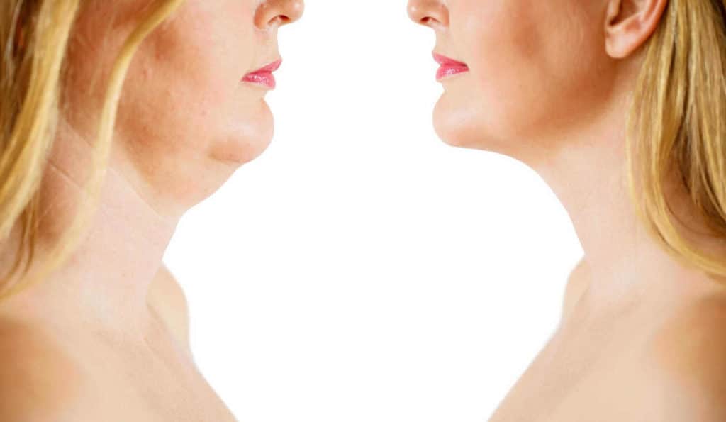 Double Chin treatment Brighton and Hove before and after results