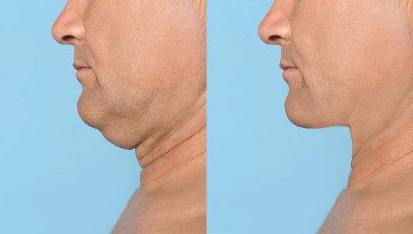 Which Non-Surgical Treatments Work Best for Jowls and Loose Skin Brighton and Hove?