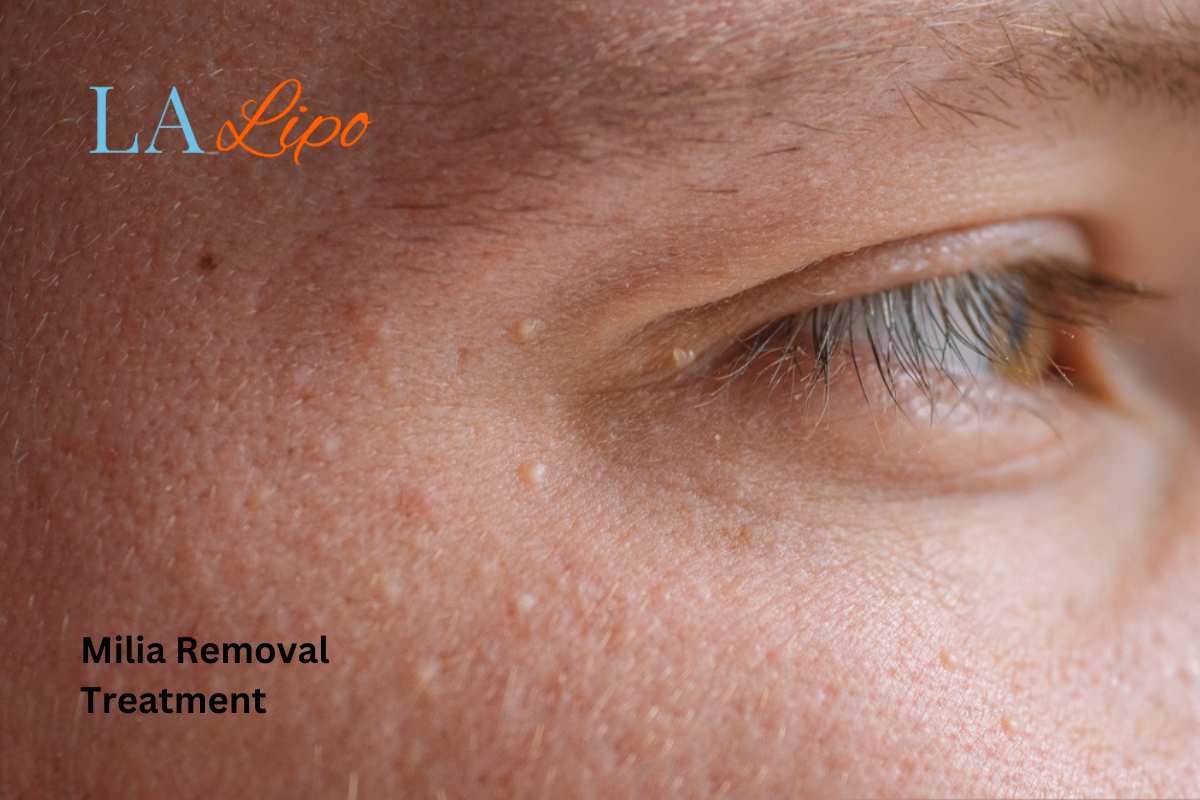 Cryopen Milia Removal: Is It the Easiest and Safest Option Brighton and Hove?