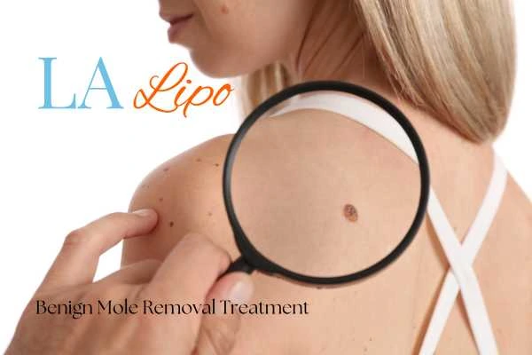 Woman having her inspection of blemish before mole removal Brighton and Hove