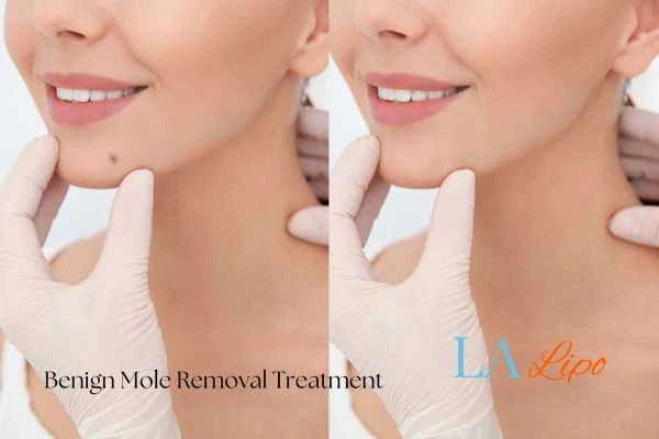 woman's before and after mole removal Brighton and Hove results