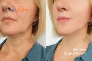 hi-fu for wrinkles Brighton and Hove before and after results
