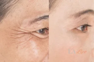 Before and after results of woman - HI-fu wrinkles reduction treatment Brighton and Hove