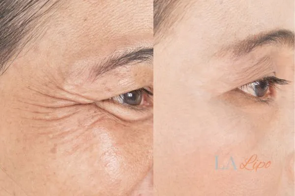 Before and after results of woman - HI-fu wrinkles reduction treatment Brighton and Hove