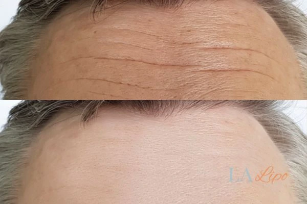 results of HIFU Brighton and Hove on mans forehead to help reduce lines and wrinkles