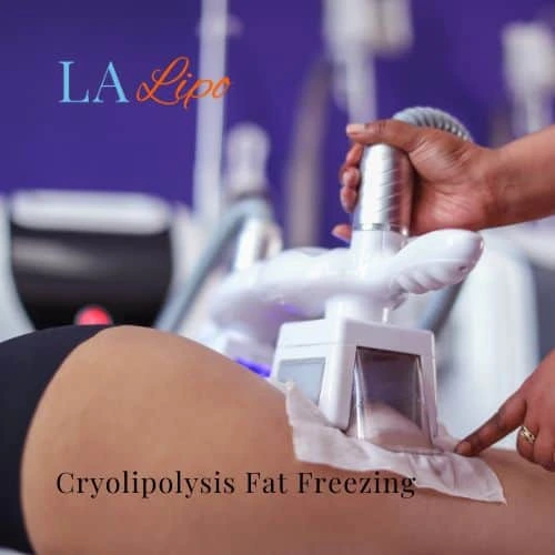 fat freezing - Cryolipolysis Brighton and Hove
