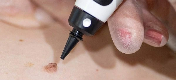 skin tag removal using cryopen Brighton and Hove