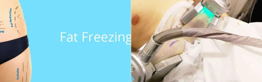 Fat freezing Brighton and Hove on multiple areas of the body