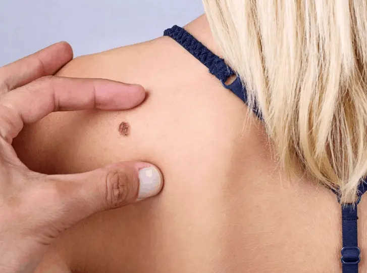 woman having mole removal Brighton and Hove consultation before treatment.