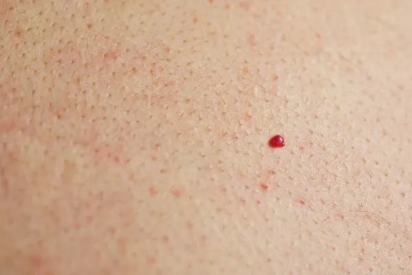 close up of a cherry angioma Brighton and Hove