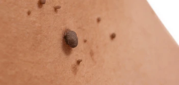 image of a skin tag Brighton and Hove