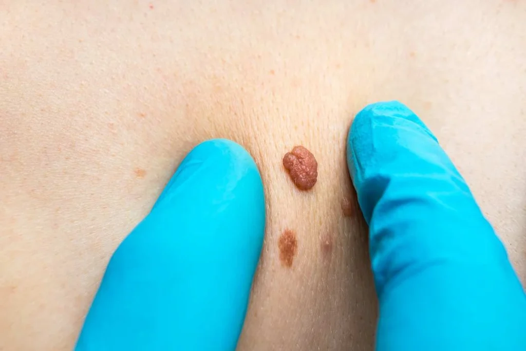 Consultant examining a skin tag Brighton and Hove