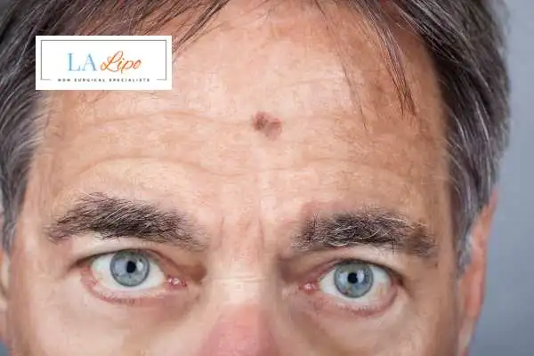 Solar Lentigo Removal Brighton and Hove image of man with mark on his forehead