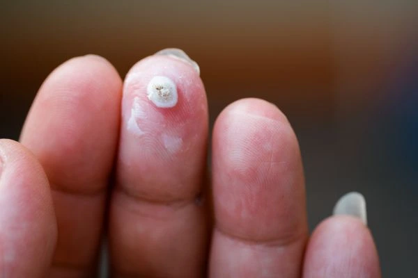 wart on person finger - cryotherapy to treat from LA LIPO Brighton and Hove