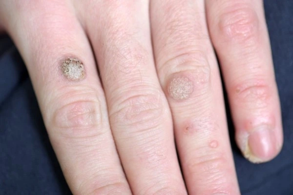 photo of warts on person hand - see wart removal Brighton and Hove from LA LIPO