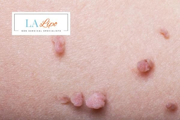 Does cryopen skin tag removal Brighton and Hove hurt? Find out now call our team today!