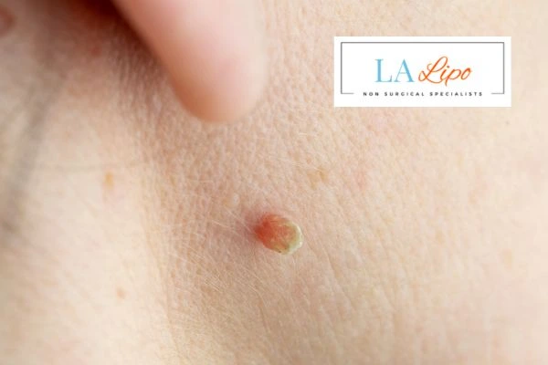 Book skin tag removal Brighton and Hove today speak to our team now!