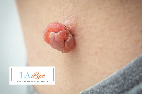 Interested in skin tag removal Brighton and Hove? Concerned about the pain? Find out more today!
