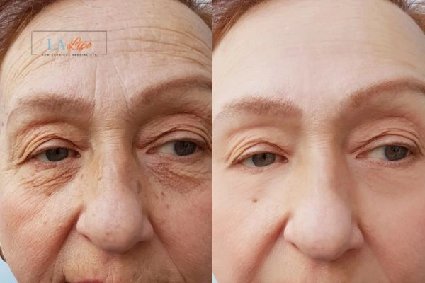 The powerful benefits of Morpheus8 Treatment Brighton and Hove - Call Our team today!