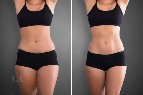 before and after results of non-surgical treatment to help a woman's body image and mental health Brighton and Hove