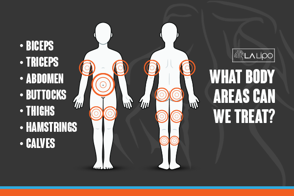 Diagram to show areas you can have LA-EMS Body Sculpting Treatment Brighton and Hove