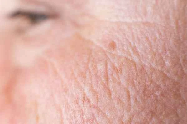 close up picture of a woman's face showing an age spot Brighton and Hove