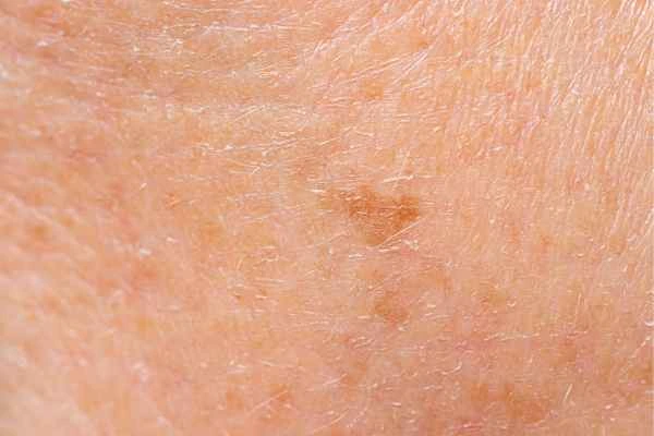 close up picture of age spots Brighton and Hove