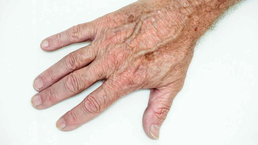 Male hand showing age spot Brighton and Hove