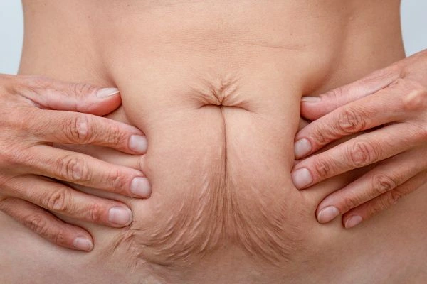 Image of a woman's stomach with loose skin - example of skin tightening Brighton and Hove options